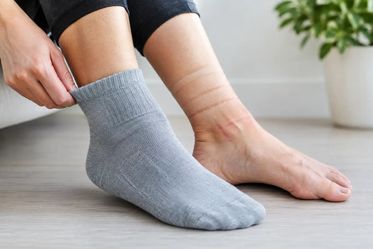 Why Socks Leave Marks on Your Legs and Feet